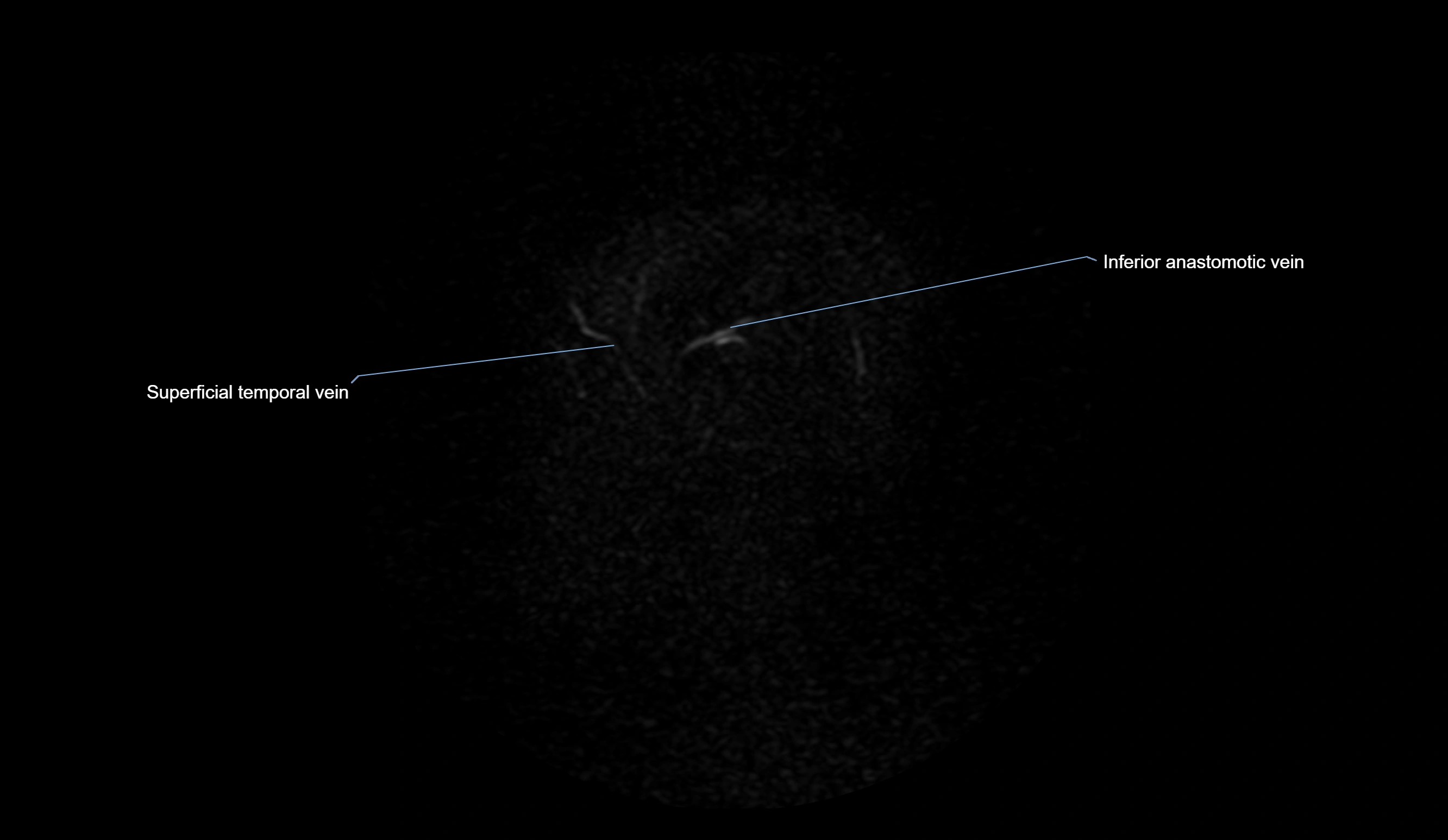 MRV brain sagittal anatomy 3T MRI labelledimages -00077.webp